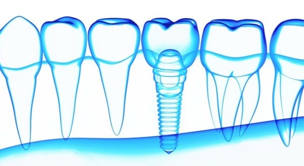 Implantes dentales de Gama Super Premium