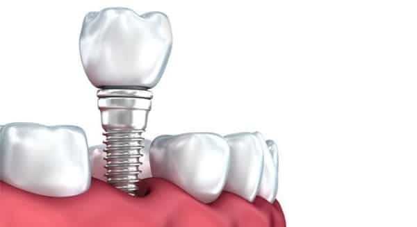 Implantes dentales de Gama