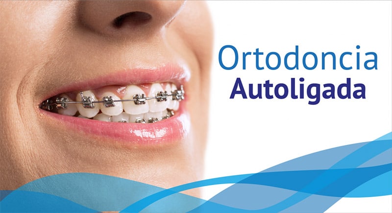 Ortodoncia autoligada