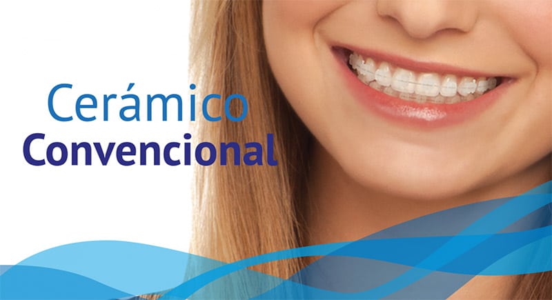 Ortodoncia cerámica convencional