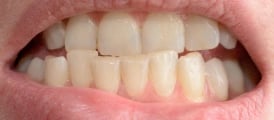ortodoncia-palmira-brackets-dientes-mal-alineados