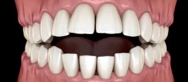 tratamiento-ortodoncia-palmira-brackets-mordida-abierta