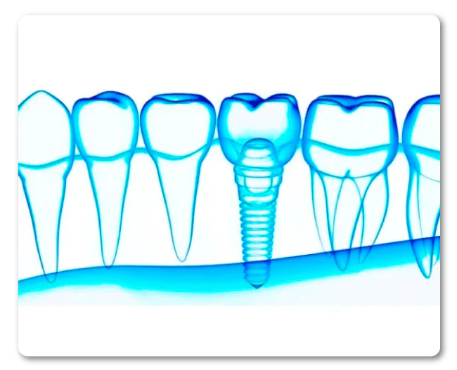 Implantes gama super premium con DentiSalud