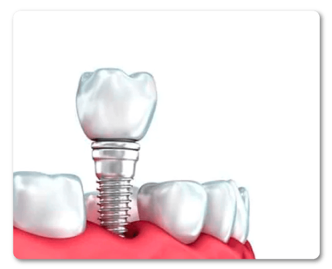 Implantes gama premium con DentiSalud