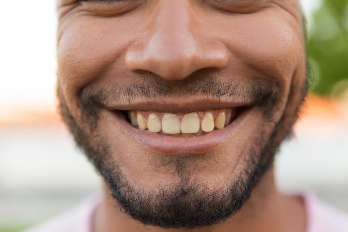 Blanqueamiento dental y dientes amarillos