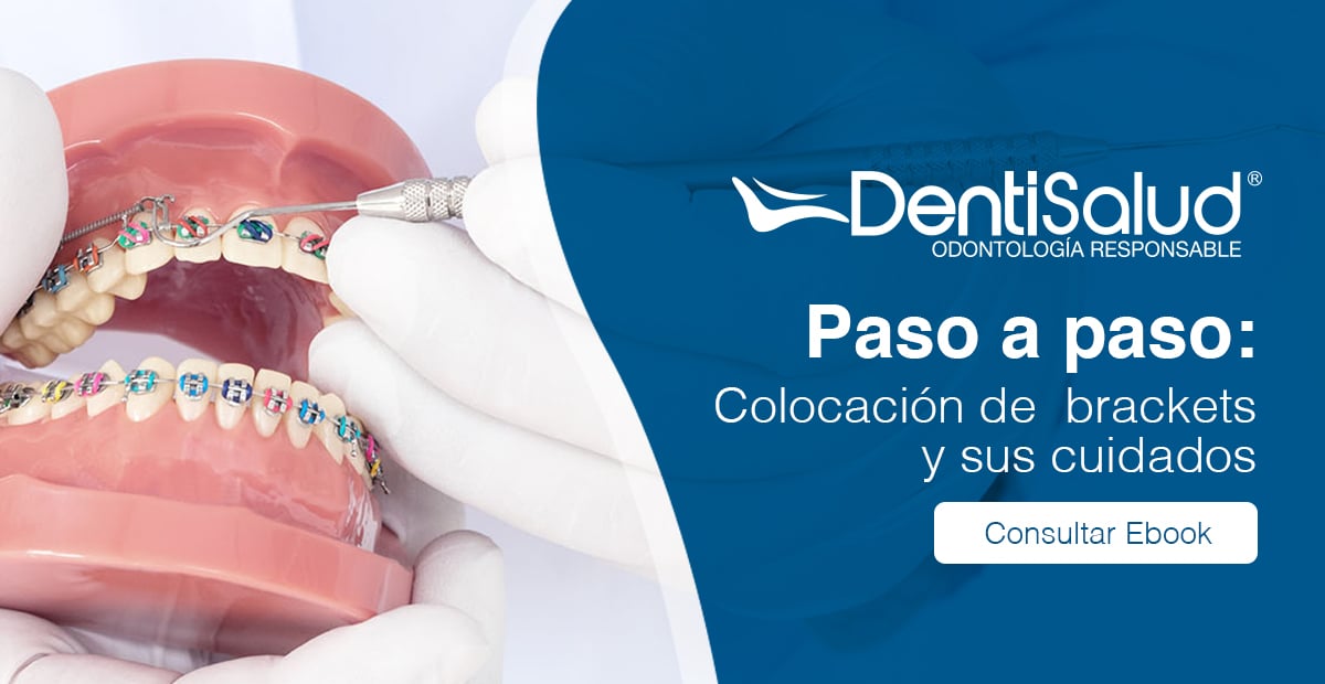 Ebook Dentisalud colocación de brackets