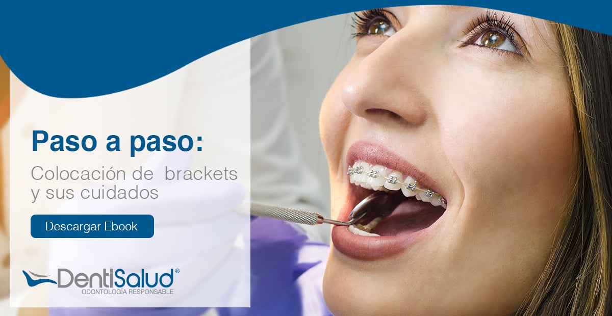 Cómo se colocan los brackets