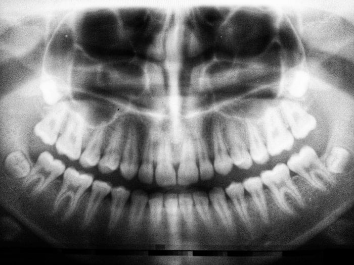 Enfermedad periodontal y reimplante de dientes
