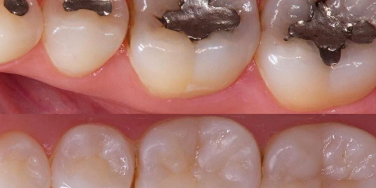 Resina para quitar caries