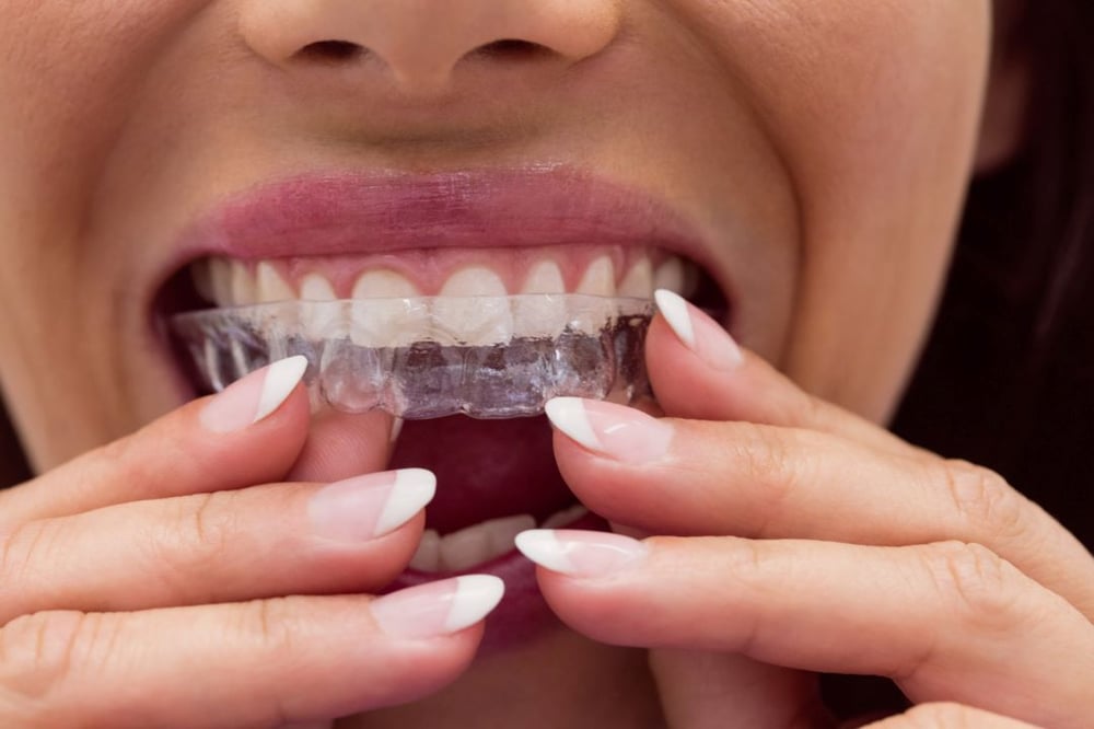 Invisalign ortodoncia invisible