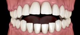 tratamiento-ortodoncia-cali-brackets-soluciona-mordida-abierta