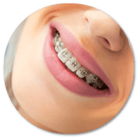 Ortodoncia con Brackets Autoligados DentiSalud