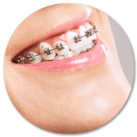 Ortodoncia Metálica DentiSalud