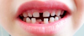  Las diastemas son el espacio excesivo entre dientes