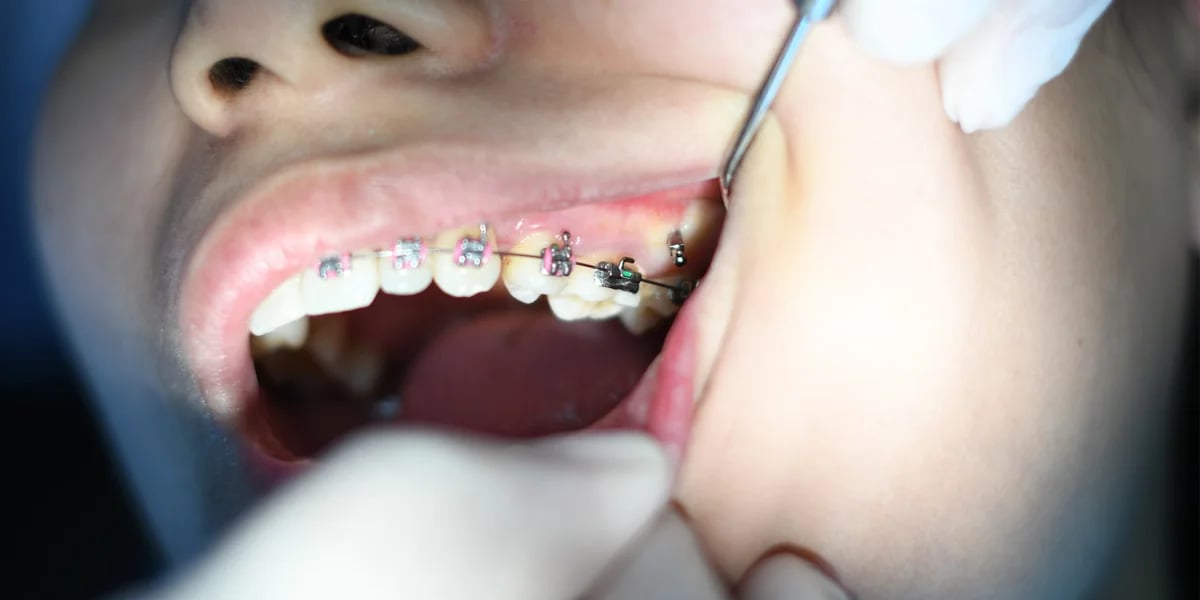 Tipos de brackets