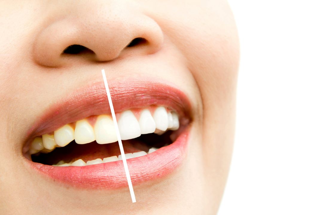 carillas-dentales-dientes-manchados-dientes-decolorados