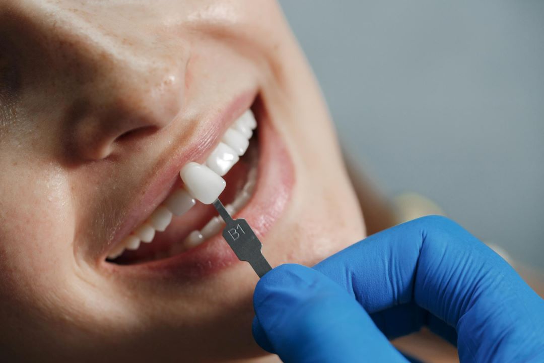 carillas-dentales-tratamiento-estetico