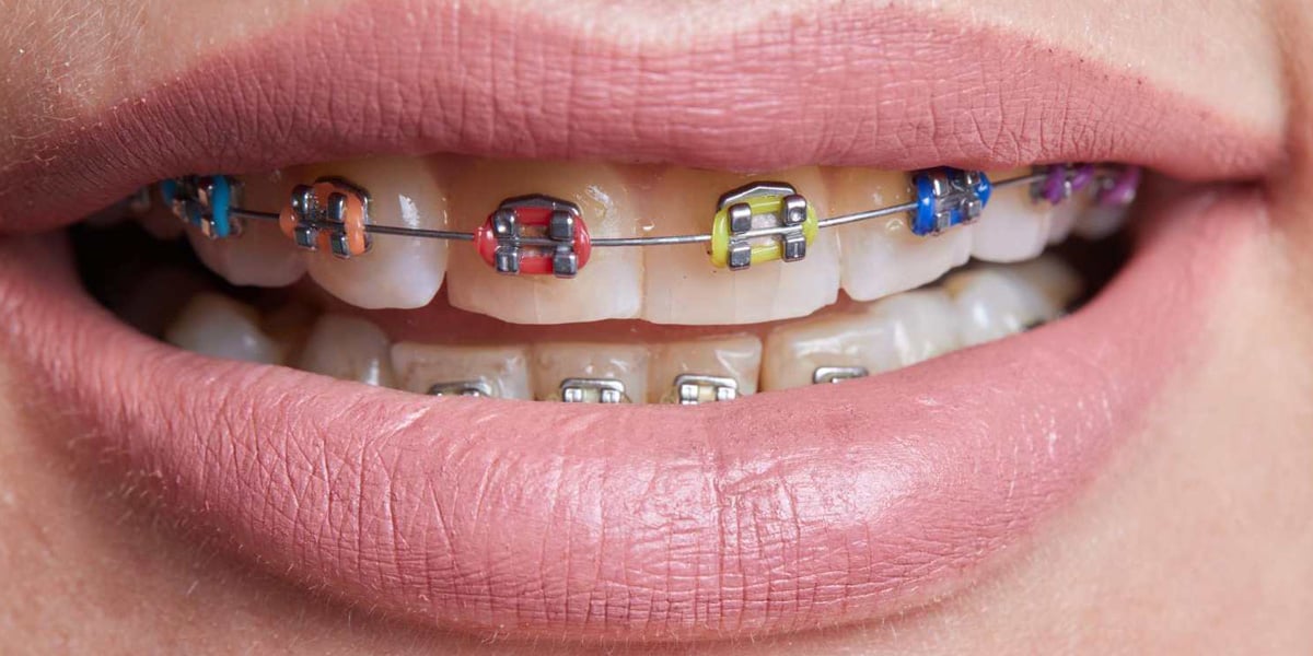 Colores de brackets y su popularidad en la ortodoncia