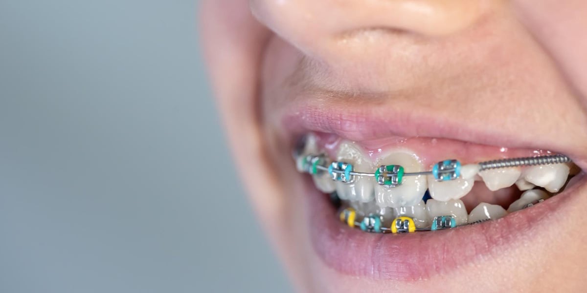 Los colores óptimos para brackets metálicos