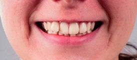 dientes-mal-alineados