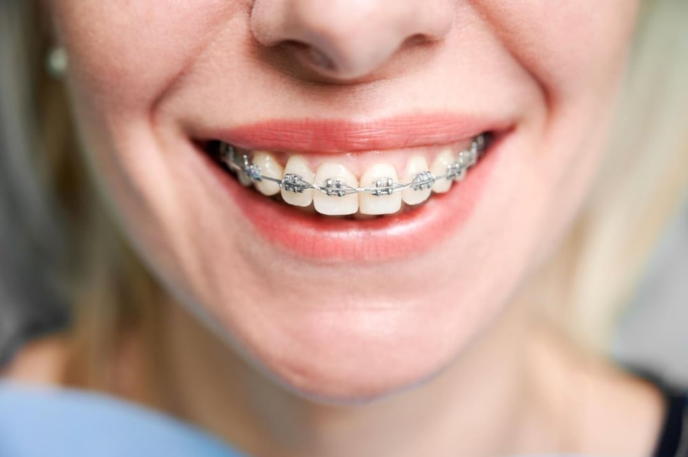 diferencia-ortodoncia-convencional-brackets-metalicos-ortodoncia-invisible