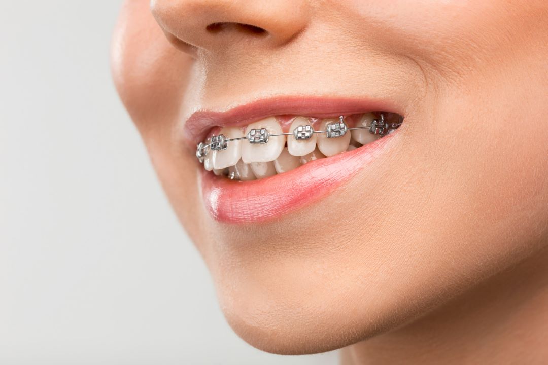 Brackets estéticos Todo lo que tienes que saber