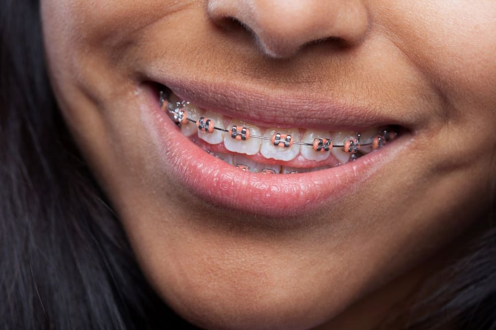 elásticos-en-ortodoncia-ayudan-alineacion-dientes-mordida