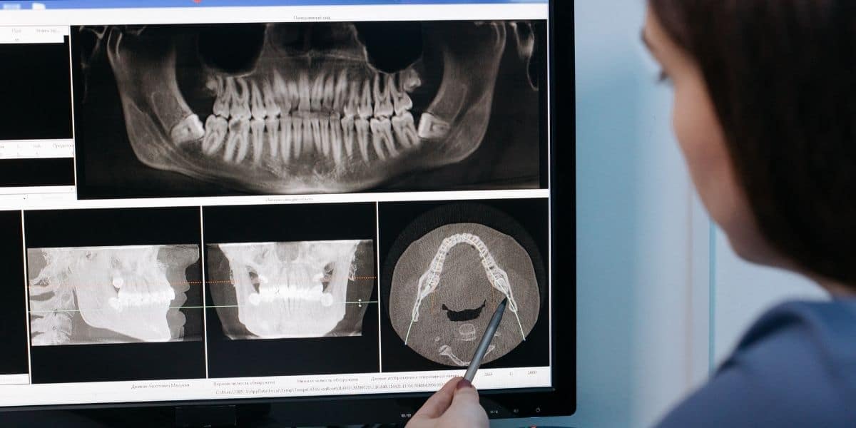 Extracción de cordales requiere valoración de ortodoncista
