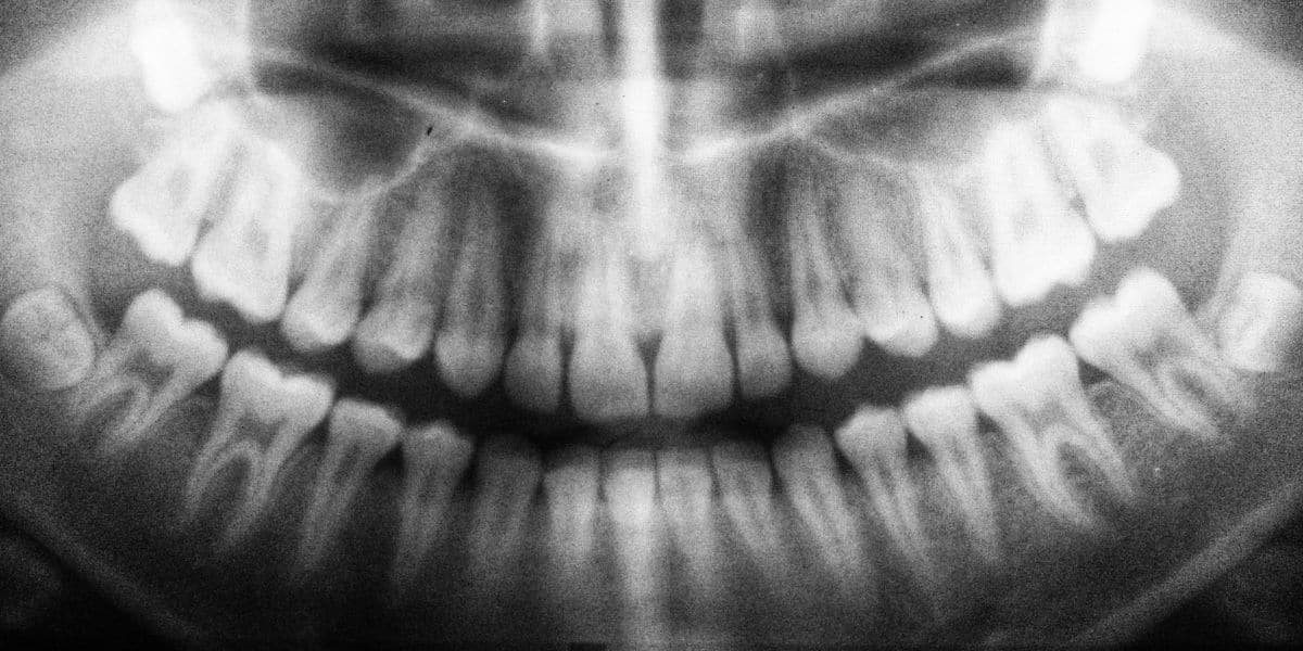 extracción-dental-maloclusión