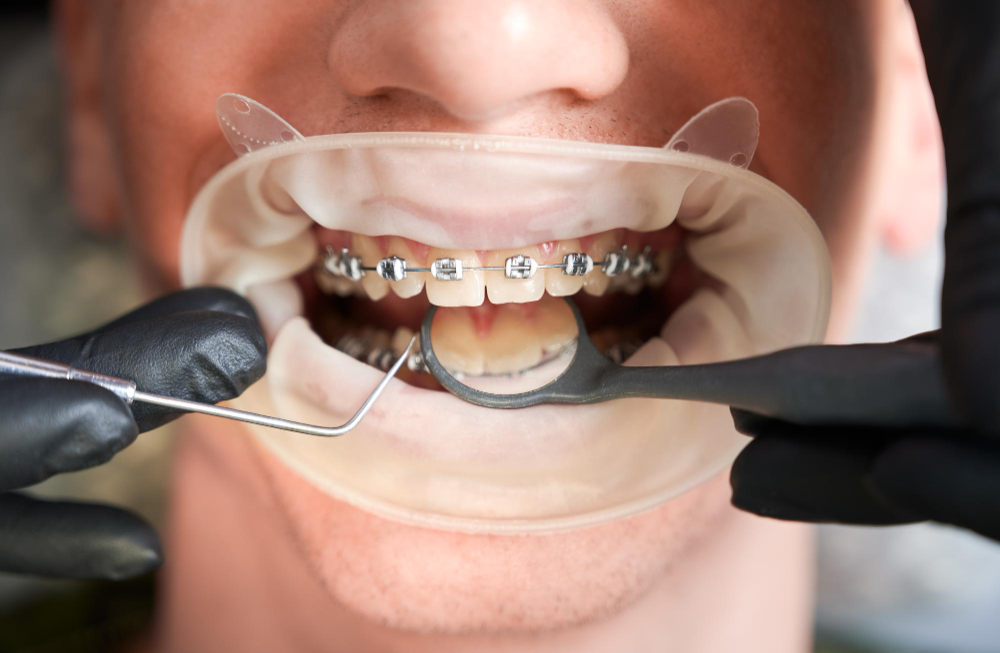 Extraer piezas dentales en ortodoncia