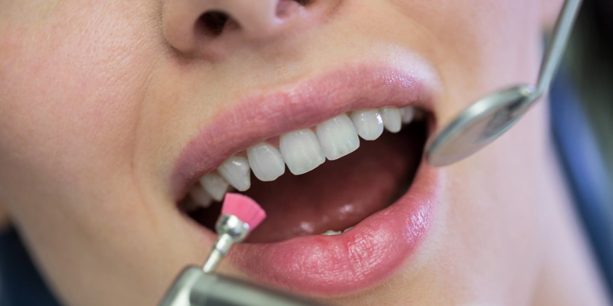 La limpieza dental juega un papel crucial en el blanqueamiento