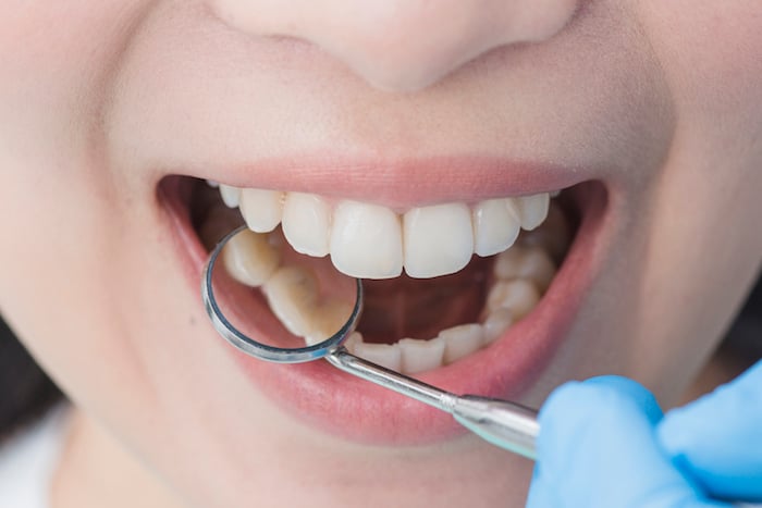 Básicos de la salud oral: ¿Cómo eliminar el sarro dental?