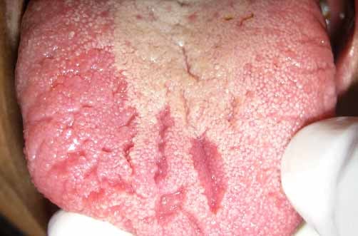 lengua-glositis-inflamación