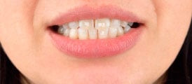 Los dientes tienen una alineación incorrecta
