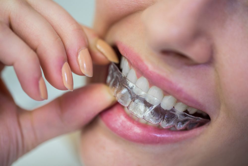 Qué son los retenedores dentales