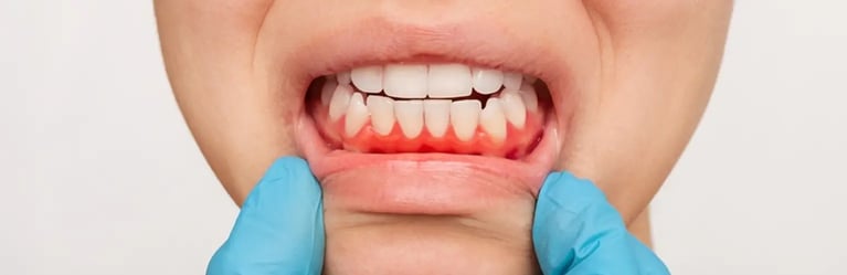 Gingivectomía o recorte de encías, ¿qué es?
