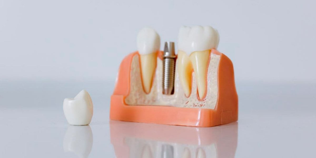 Rehabilitacion oral implantes dentales