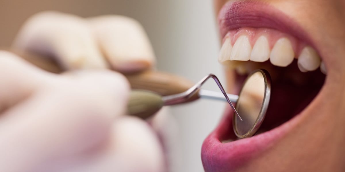 Son varios los requisitos para realizar un blanqueamiento dental