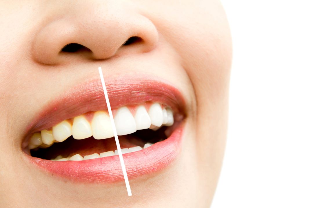 tipos-de-blanqueamiento-dental-manchas-dientes
