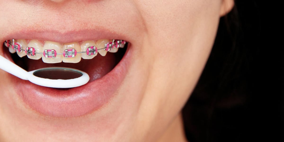 Tratamiento con brackets de colores en Dentisalud
