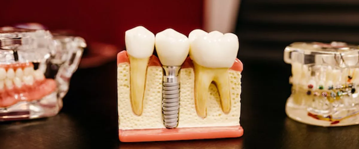 Dentisalud clínica de Salud Oral experta en implantes dentales. 