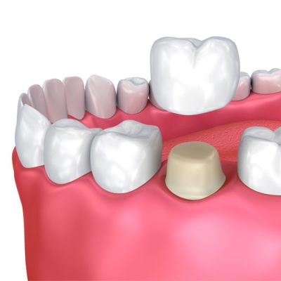 Rehabilitacion Oral