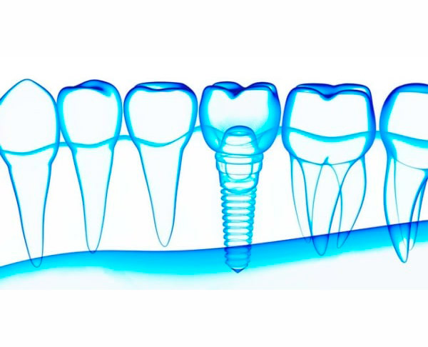 Implantes Gama Super Premium - Implantes dentales Dentisalud