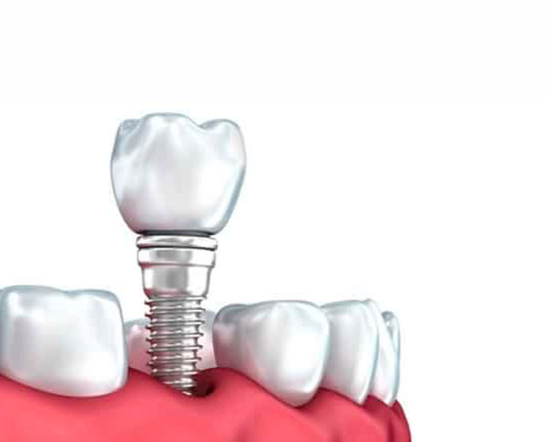 Implantes-gama-premium-Dentisalud