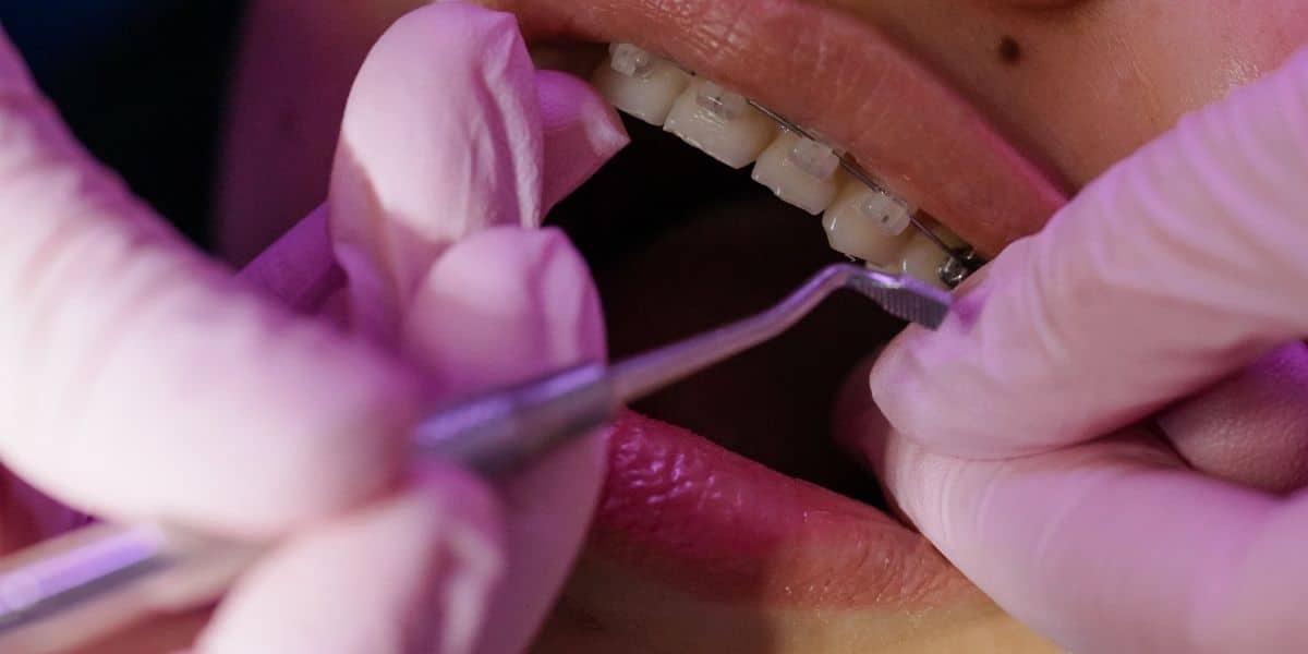 Ortodoncia con extracción de cordales y premolares: ¿Es necesario?
