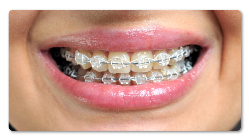 Ortodoncia Cerámico Convencional - Dentisalud