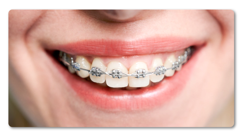 Ortodoncia Medicada con DentiSalud