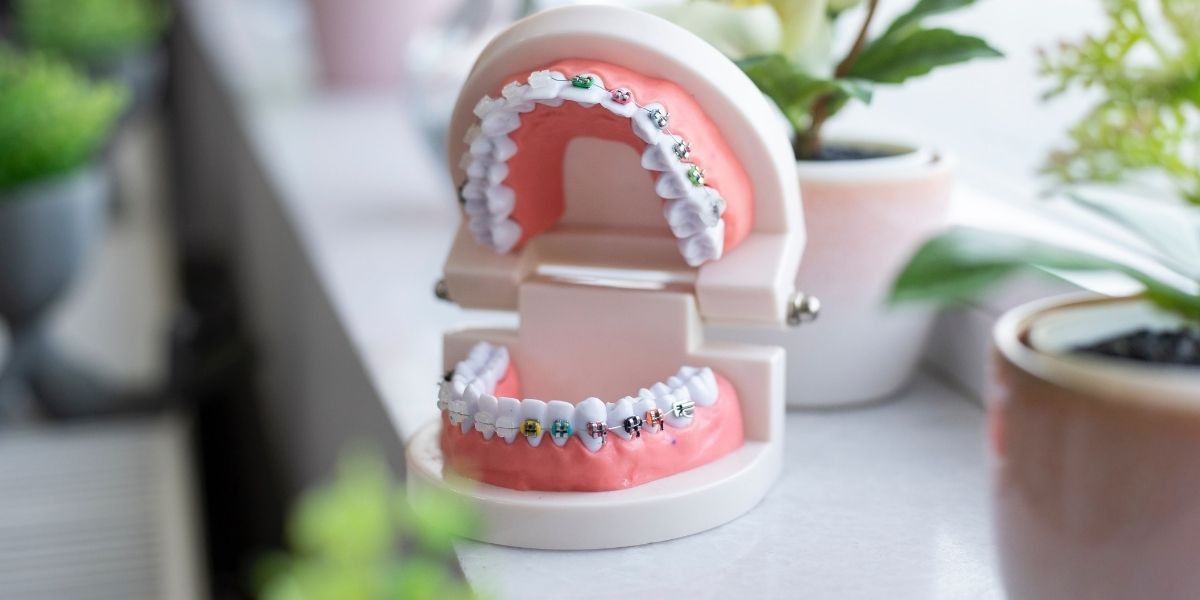 Conoce los beneficios de tener brackets