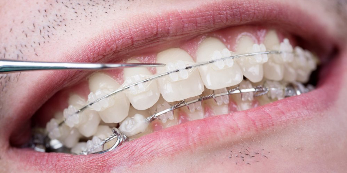 Ventajas que brindan los brackets cerámicos