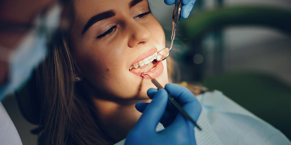 Cuidados para los brackets de cerámica